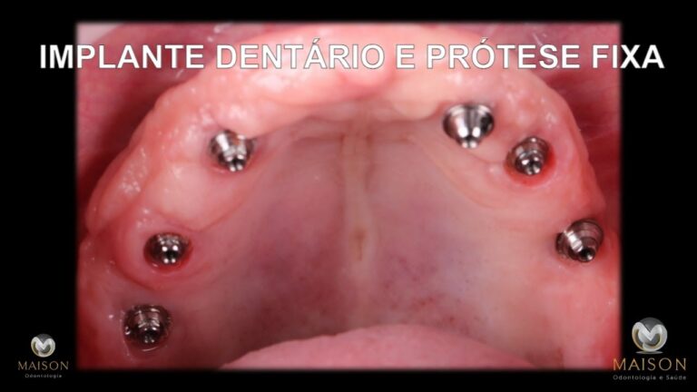 Implante Dentário: Tudo o Que Você Precisa Saber