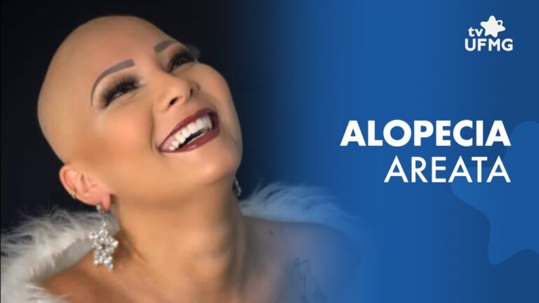 Alopecia Areata Feminina: Causas, Sintomas e Tratamentos