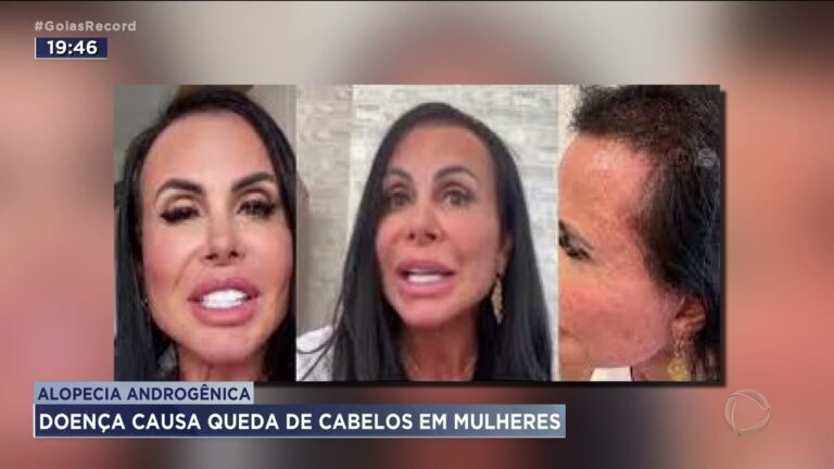 Principais causas da alopecia feminina