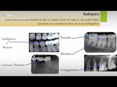 Diferença entre Radiolúcido e Radiopaco: Entenda as Características