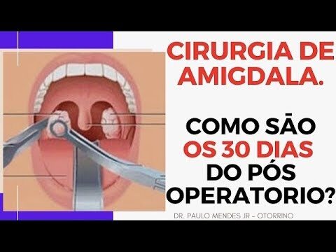Opera&ccedil;&atilde;o das Am&iacute;gdalas: O Que Voc&ecirc; Precisa Saber